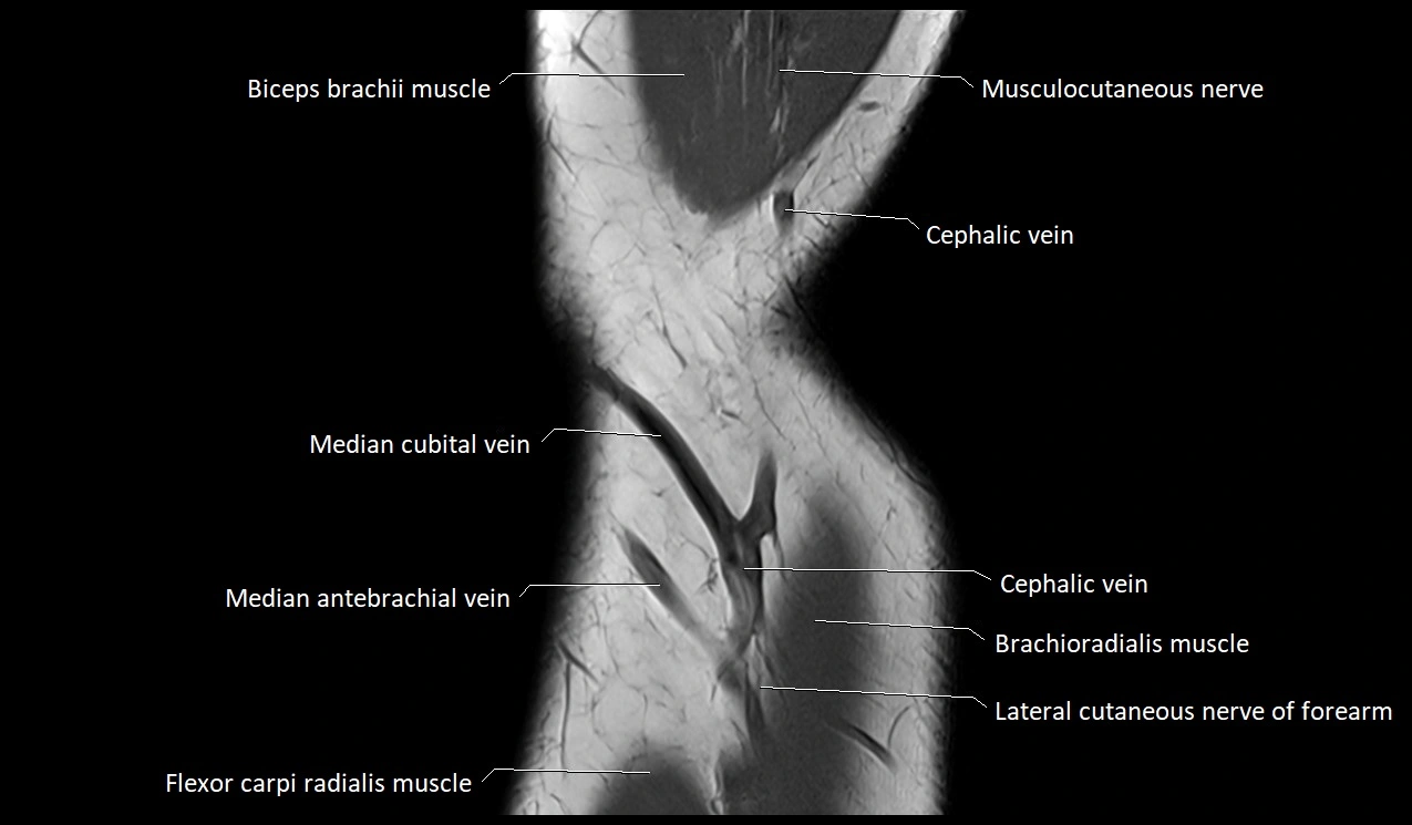 Elbow coronal anatomy image  cross sectional 3T MRI image 4.webp